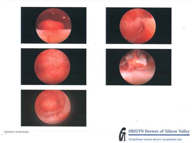Outpatient Surgery of Operative Hysteroscopy